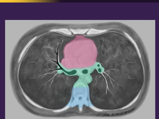 Mediastinal  Pathology  Compartmental  Approach