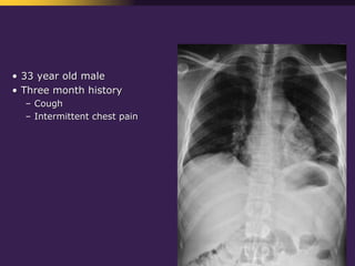 Mediastinal  Pathology  Compartmental  Approach