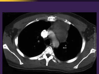 Mediastinal  Pathology  Compartmental  Approach