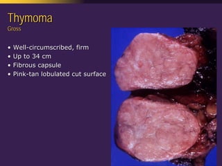 Mediastinal  Pathology  Compartmental  Approach