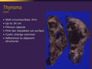 Mediastinal  Pathology  Compartmental  Approach