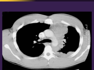 Mediastinal  Pathology  Compartmental  Approach
