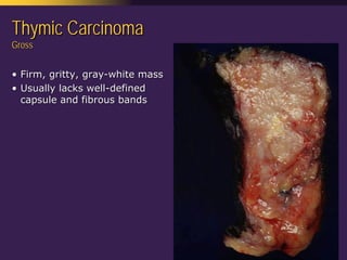 Mediastinal  Pathology  Compartmental  Approach