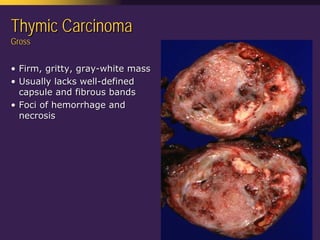 Mediastinal  Pathology  Compartmental  Approach
