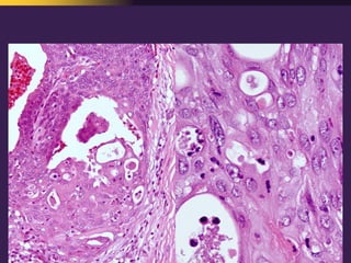 Mediastinal  Pathology  Compartmental  Approach