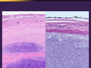 Mediastinal  Pathology  Compartmental  Approach