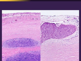 Mediastinal  Pathology  Compartmental  Approach