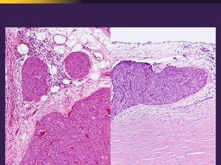 Mediastinal  Pathology  Compartmental  Approach