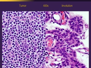 Mediastinal  Pathology  Compartmental  Approach