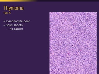 Mediastinal  Pathology  Compartmental  Approach
