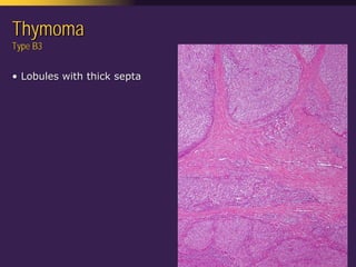 Mediastinal  Pathology  Compartmental  Approach