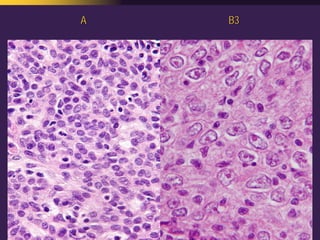 Mediastinal  Pathology  Compartmental  Approach