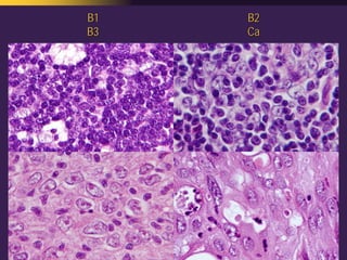 Mediastinal  Pathology  Compartmental  Approach