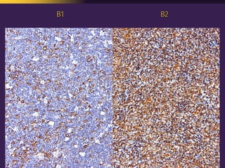 Mediastinal  Pathology  Compartmental  Approach