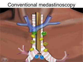 Conventional medastinoscopy 
 