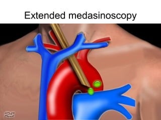 Extended medasinoscopy 
 