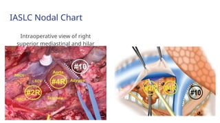 Current Evidences on Mediastinal Lymph Node Dissection for Lung Cancer ...