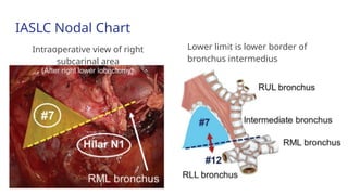 Current Evidences on Mediastinal Lymph Node Dissection for Lung Cancer ...