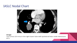 Current Evidences on Mediastinal Lymph Node Dissection for Lung Cancer ...