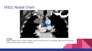 Current Evidences on Mediastinal Lymph Node Dissection for Lung Cancer ...