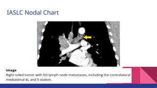 Current Evidences on Mediastinal Lymph Node Dissection for Lung Cancer ...