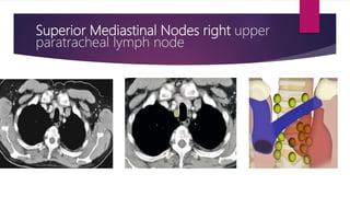 Superior Mediastinal Nodes right upper
paratracheal lymph node
 