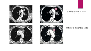 Anterior to arch of aorta
Anterior to descending aorta
 