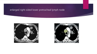 enlarged right-sided lower pretracheal lymph node
 