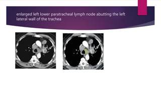 enlarged left lower paratracheal lymph node abutting the left
lateral wall of the trachea
 