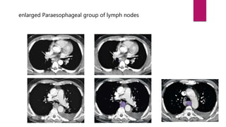enlarged Paraesophageal group of lymph nodes
 