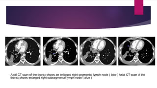 Axial CT scan of the thorax shows an enlarged right segmental lymph node ( blue ) Axial CT scan of the
thorax shows enlarged right subsegmental lymph node ( blue )
 