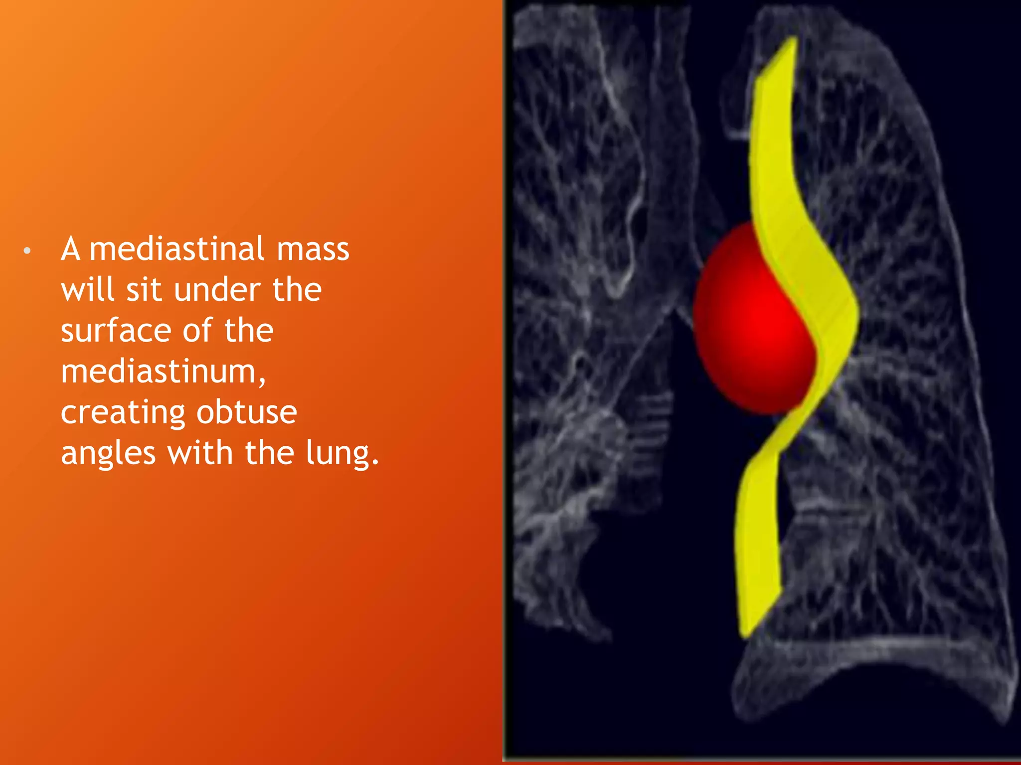 • A mediastinal mass
will sit under the
surface of the
mediastinum,
creating obtuse
angles with the lung.
 