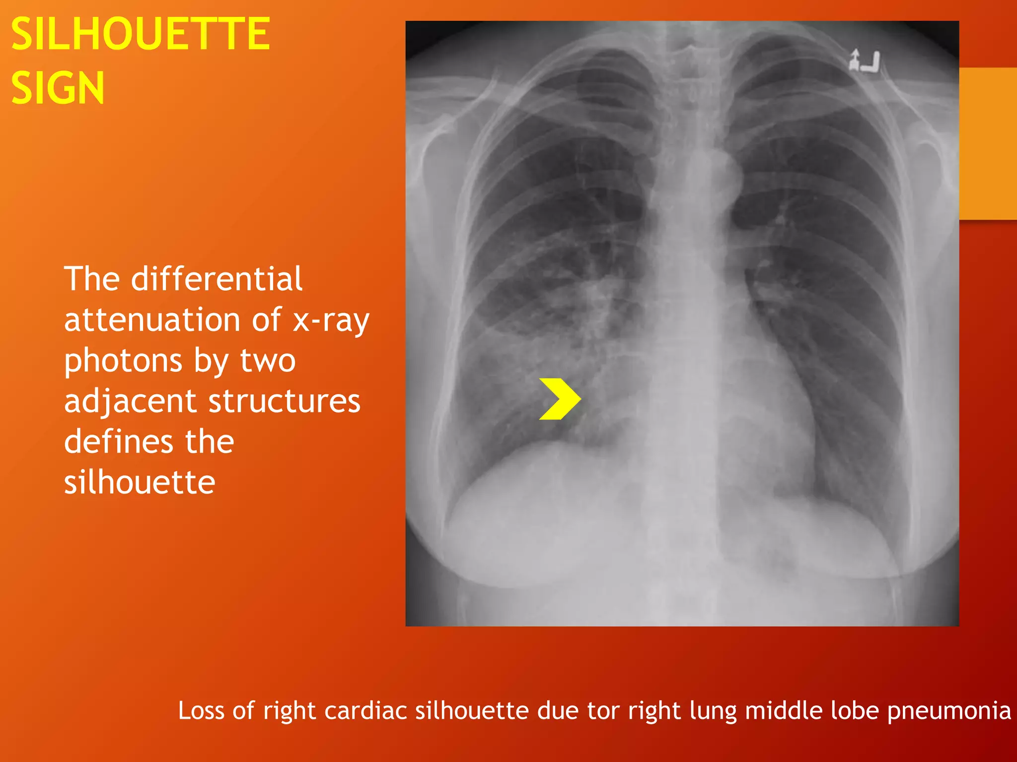 The differential
attenuation of x-ray
photons by two
adjacent structures
defines the
silhouette
SILHOUETTE
SIGN
Loss of right cardiac silhouette due tor right lung middle lobe pneumonia
 