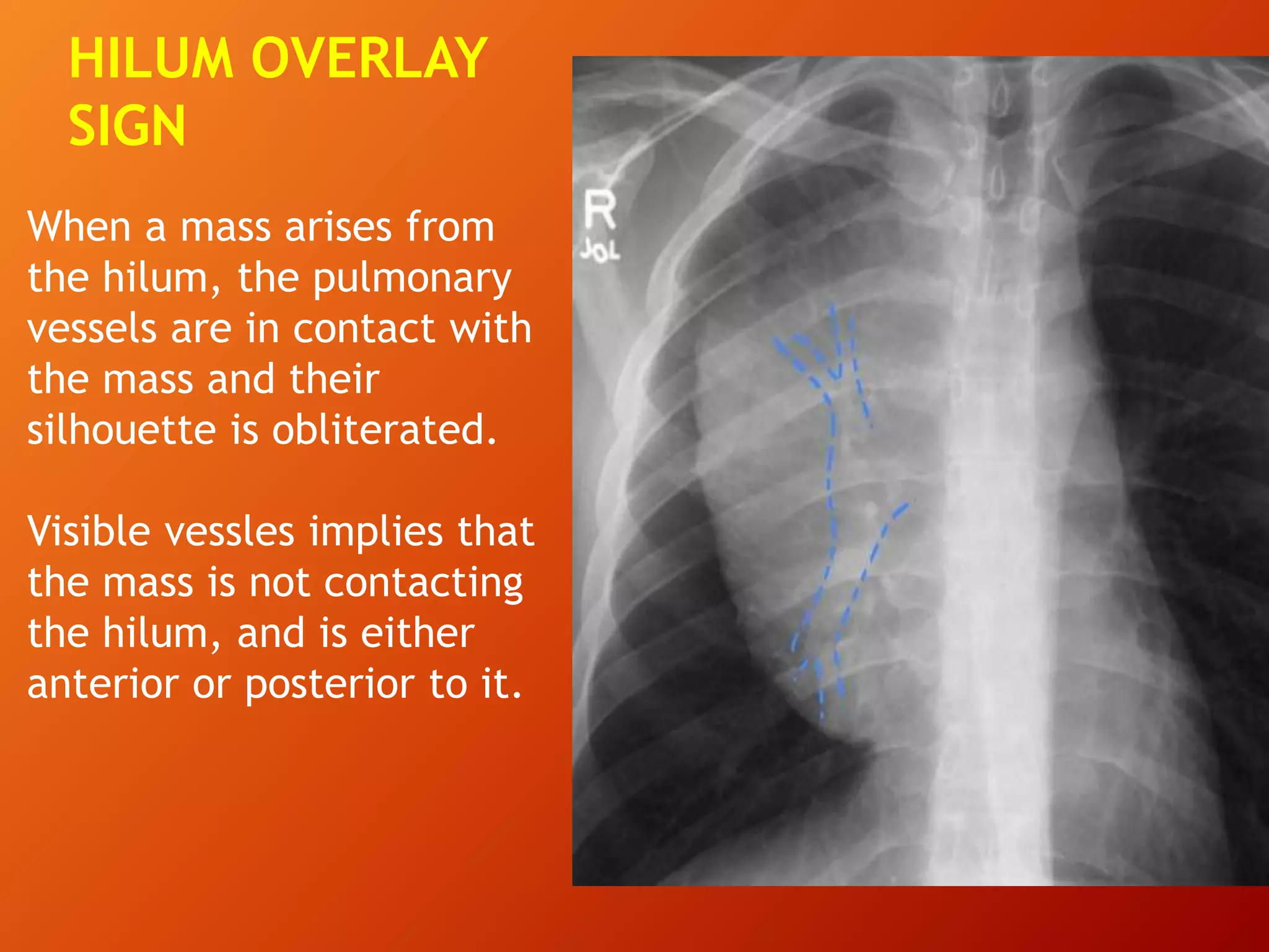 When a mass arises from
the hilum, the pulmonary
vessels are in contact with
the mass and their
silhouette is obliterated.
Visible vessles implies that
the mass is not contacting
the hilum, and is either
anterior or posterior to it.
HILUM OVERLAY
SIGN
 