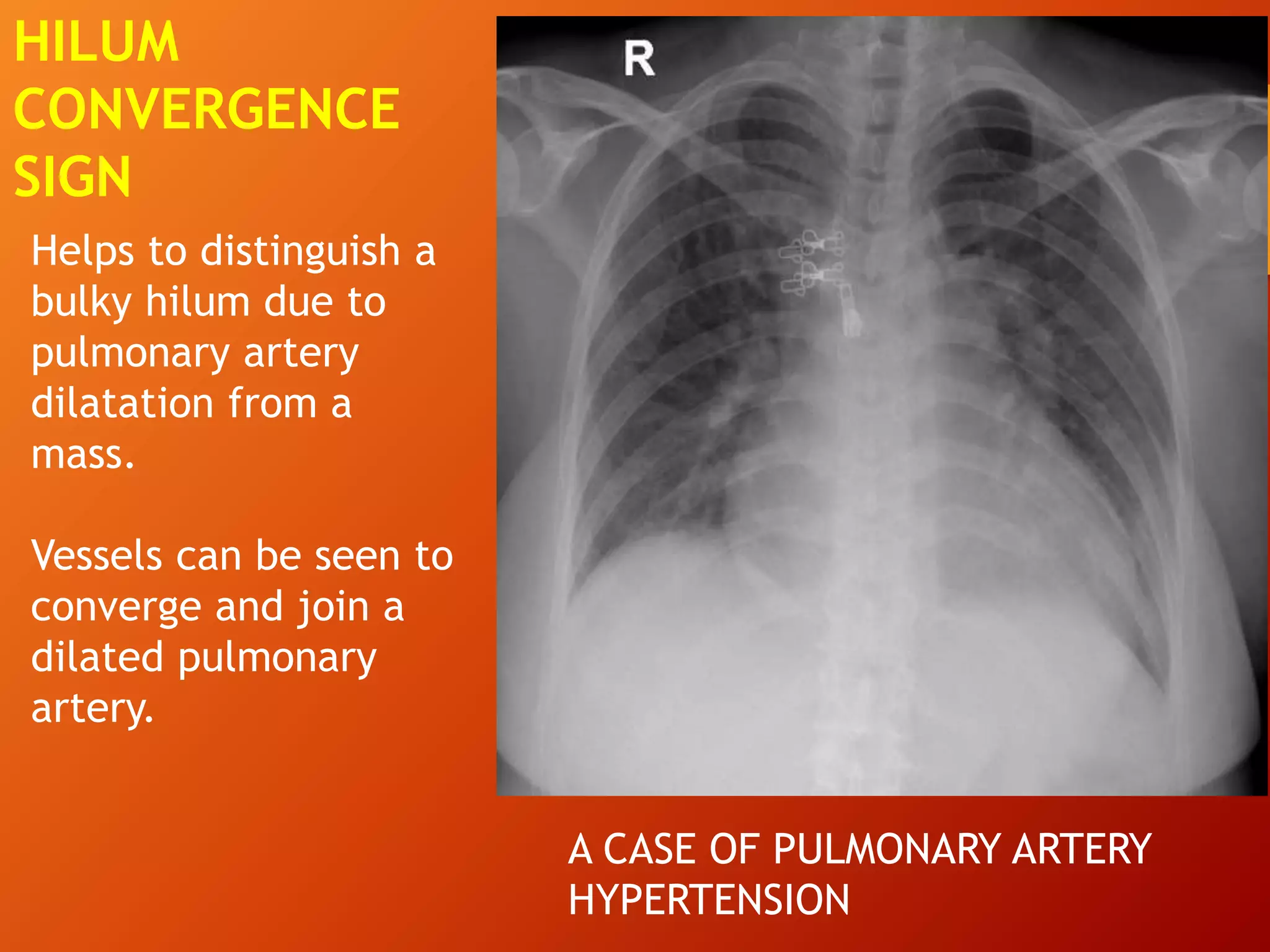 Helps to distinguish a
bulky hilum due to
pulmonary artery
dilatation from a
mass.
Vessels can be seen to
converge and join a
dilated pulmonary
artery.
HILUM
CONVERGENCE
SIGN
A CASE OF PULMONARY ARTERY
HYPERTENSION
 