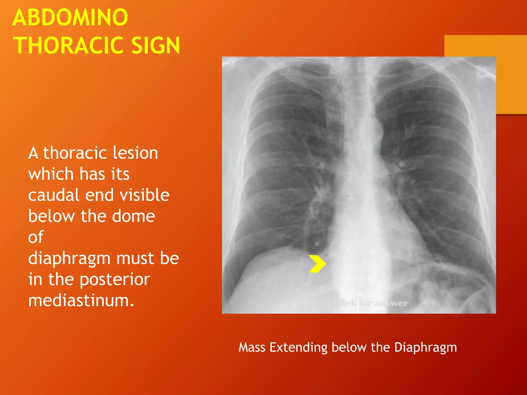 ABDOMINO
THORACIC SIGN
A thoracic lesion
which has its
caudal end visible
below the dome
of
diaphragm must be
in the posterior
mediastinum.
Mass Extending below the Diaphragm
 