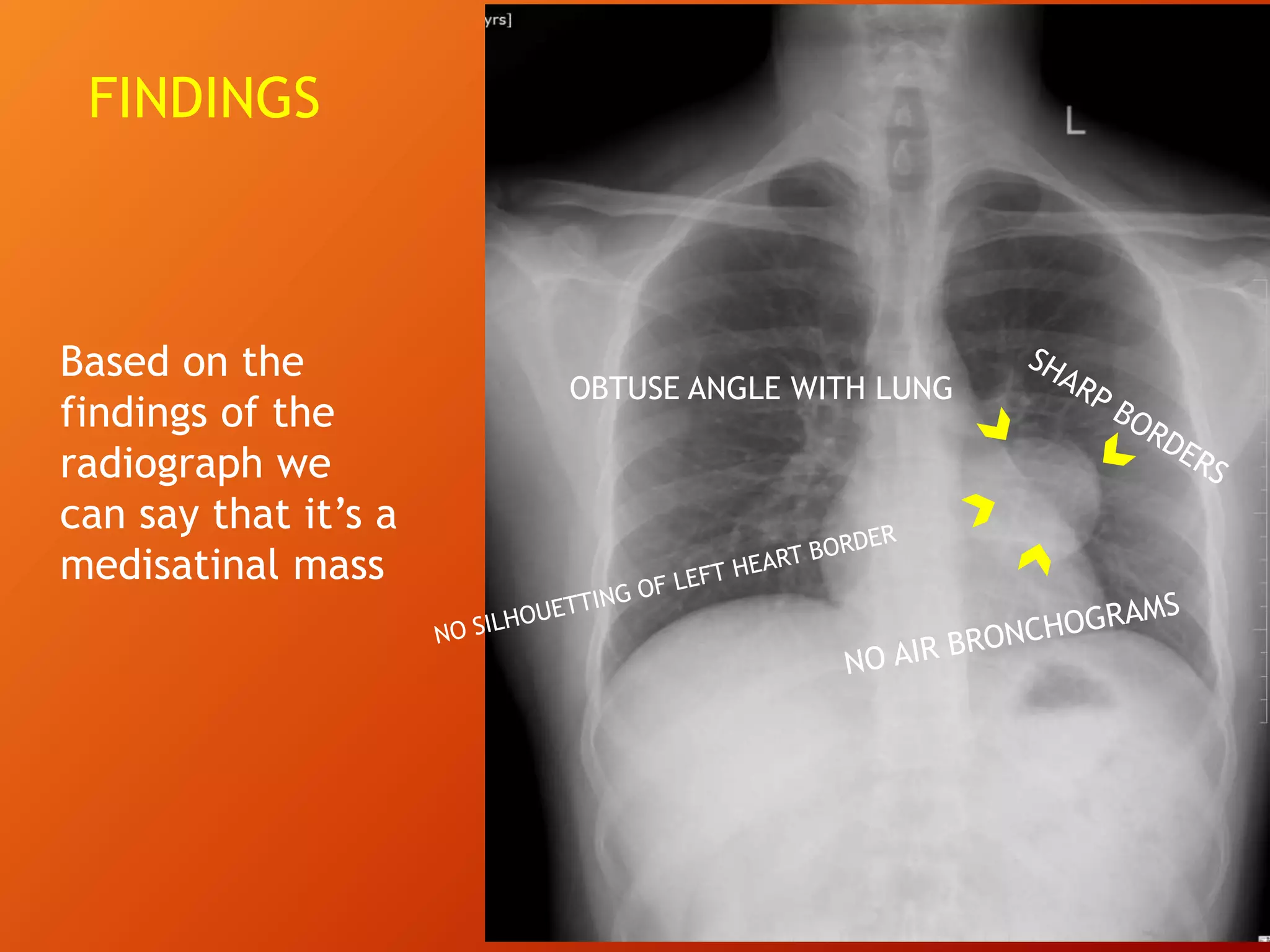 OBTUSE ANGLE WITH LUNG
Based on the
findings of the
radiograph we
can say that it’s a
medisatinal mass
FINDINGS
 