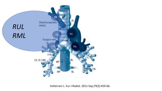 RUL
RML
2R
4R
10R
Volterrani L. Eur J Radiol. 2011 Sep;79(3):459-66.
 