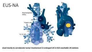 EUS-NA
9R 9L
8R
8L
7
4L
5
Used mostly to corroborate tumor involvement in enlarged LN in EUS-reachable LN stations
 