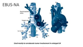 EBUS-NA
Used mostly to corroborate tumor involvement in enlarged LN
 