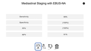 83
Mediastinal Staging with EBUS-NA
Sensitivity
PPVSpecificity
NPV
PPV
89%
(100%)
(100%)
91%
 