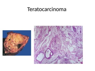 Teratocarcinoma
 