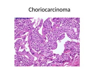Choriocarcinoma
 