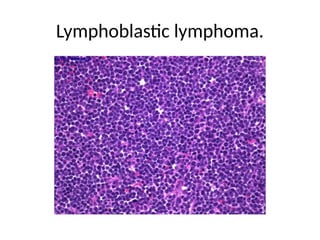 Lymphoblastic lymphoma.
 