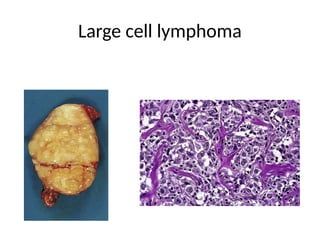 Large cell lymphoma
 