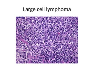 Large cell lymphoma
 