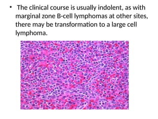 • The clinical course is usually indolent, as with
marginal zone B-cell lymphomas at other sites,
there may be transformation to a large cell
lymphoma.
 