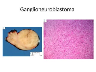 Ganglioneuroblastoma
 
