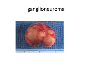 ganglioneuroma
 
