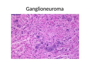 Ganglioneuroma
 